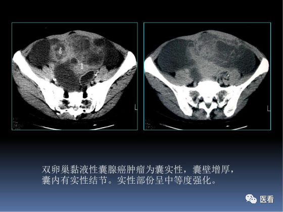 【PPT】卵巢恶性肿瘤的CT诊断