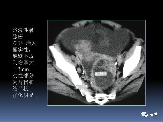 【PPT】卵巢恶性肿瘤的CT诊断