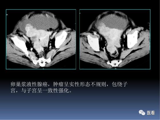 【PPT】卵巢恶性肿瘤的CT诊断