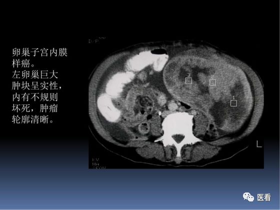 【PPT】卵巢恶性肿瘤的CT诊断
