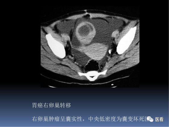 【PPT】卵巢恶性肿瘤的CT诊断