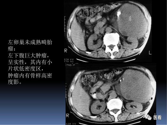【PPT】卵巢恶性肿瘤的CT诊断