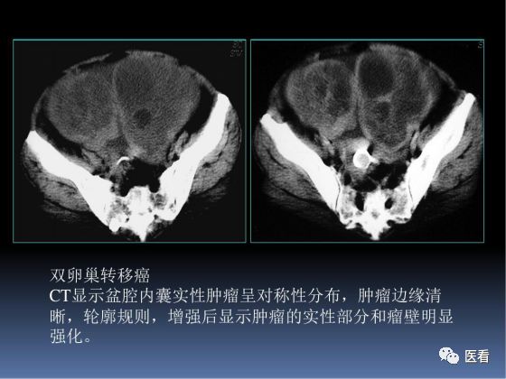 【PPT】卵巢恶性肿瘤的CT诊断