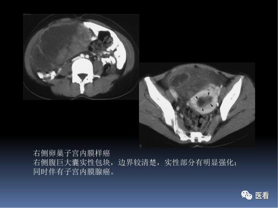 【PPT】卵巢恶性肿瘤的CT诊断
