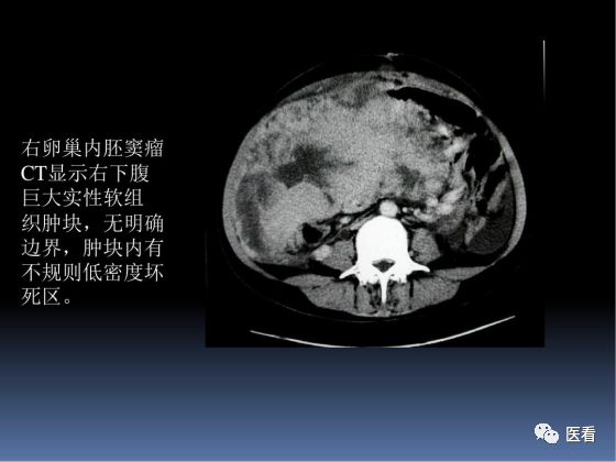 【PPT】卵巢恶性肿瘤的CT诊断