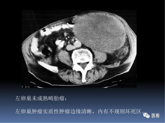 【PPT】卵巢恶性肿瘤的CT诊断