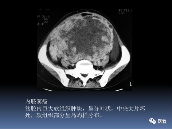 【PPT】卵巢恶性肿瘤的CT诊断