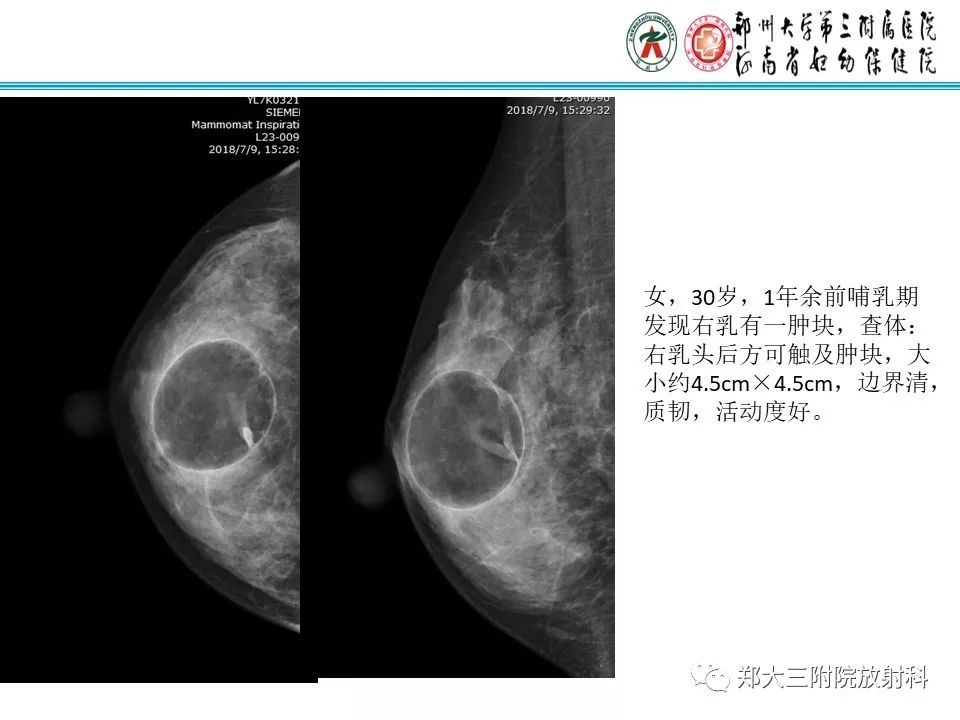 【PPT】乳腺囊肿的X线表现 【PPT】乳腺囊肿的X线表现