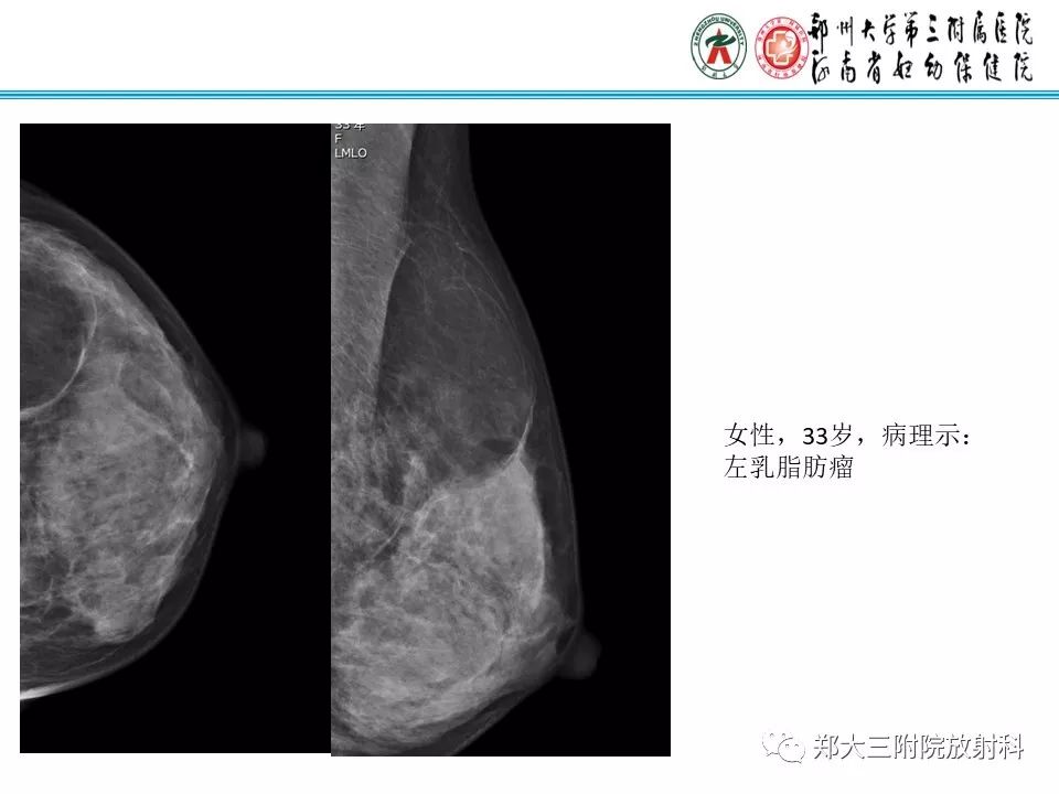 【PPT】乳腺囊肿的X线表现 【PPT】乳腺囊肿的X线表现