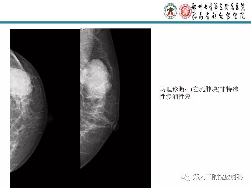 【PPT】乳腺囊肿的X线表现 【PPT】乳腺囊肿的X线表现