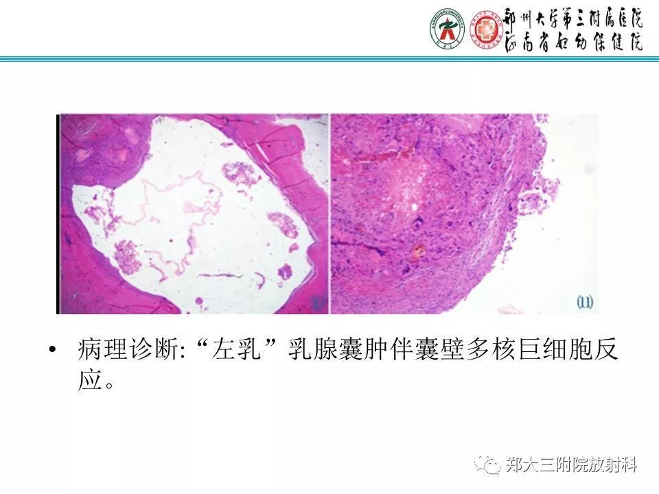 【PPT】乳腺囊肿的X线表现 【PPT】乳腺囊肿的X线表现