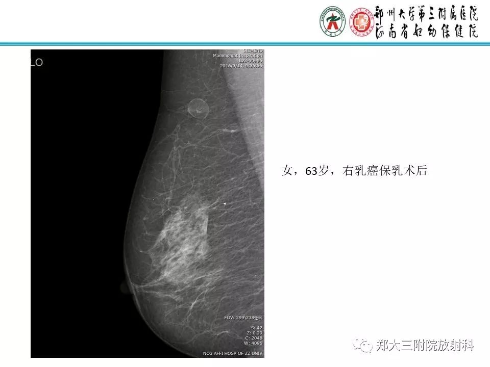 【PPT】乳腺囊肿的X线表现 【PPT】乳腺囊肿的X线表现