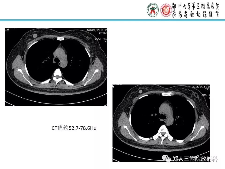 【PPT】乳腺囊肿的X线表现 【PPT】乳腺囊肿的X线表现