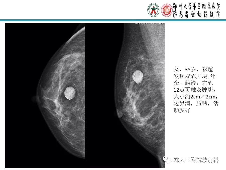 【PPT】乳腺囊肿的X线表现 【PPT】乳腺囊肿的X线表现