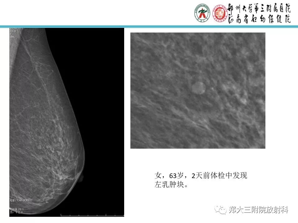 【PPT】乳腺囊肿的X线表现 【PPT】乳腺囊肿的X线表现