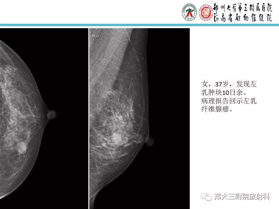 【PPT】乳腺囊肿的X线表现 【PPT】乳腺囊肿的X线表现