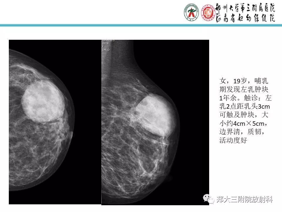 【PPT】乳腺囊肿的X线表现 【PPT】乳腺囊肿的X线表现
