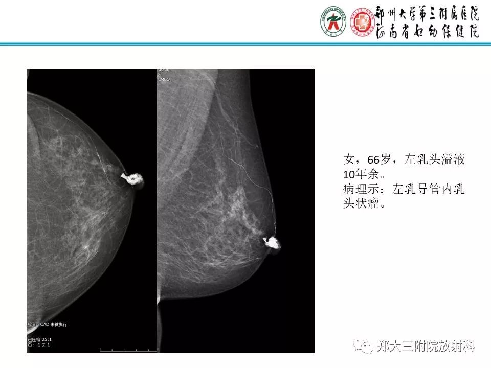 【PPT】乳腺囊肿的X线表现 【PPT】乳腺囊肿的X线表现