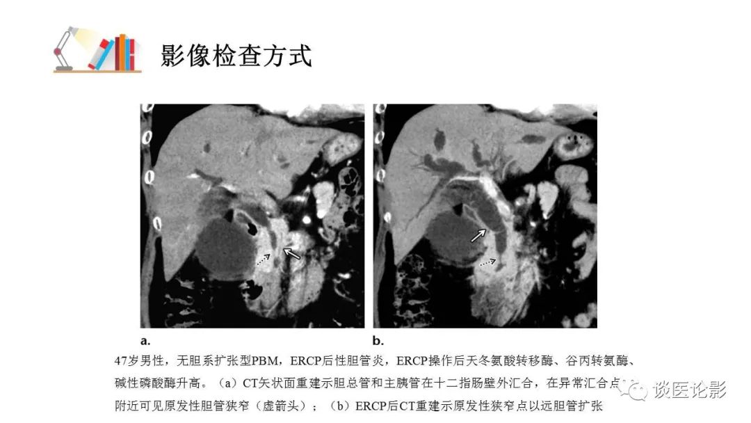 【PPT】胰—胆管合流异常影像表现