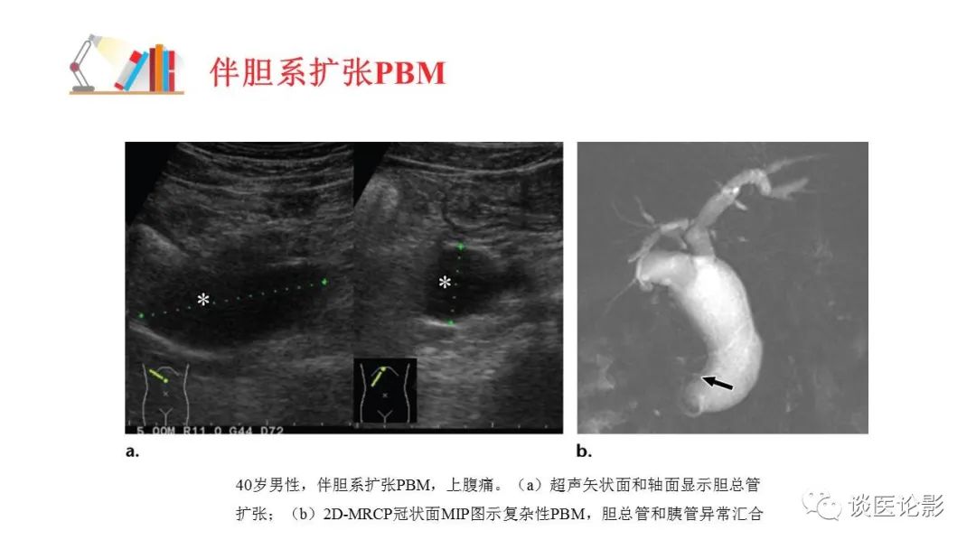 【PPT】胰—胆管合流异常影像表现