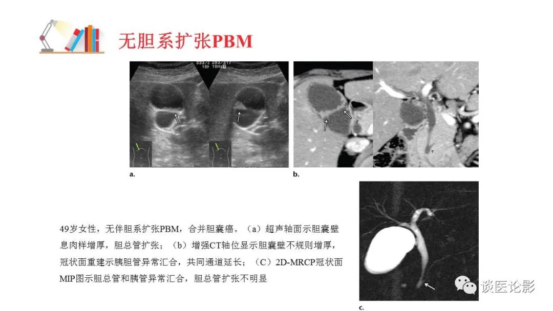 【PPT】胰—胆管合流异常影像表现