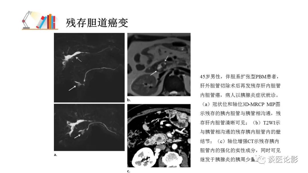 【PPT】胰—胆管合流异常影像表现