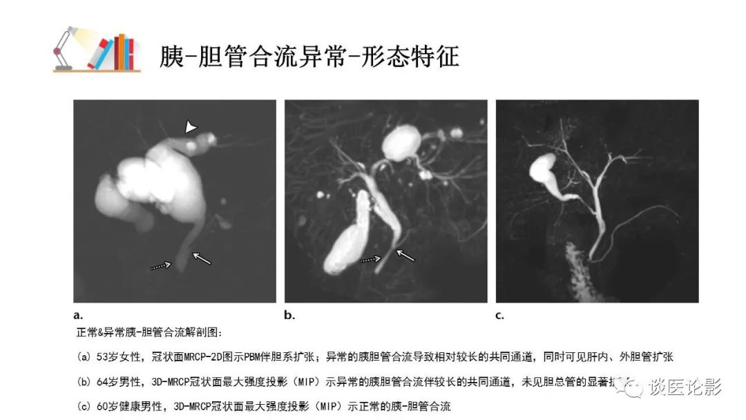 【PPT】胰—胆管合流异常影像表现