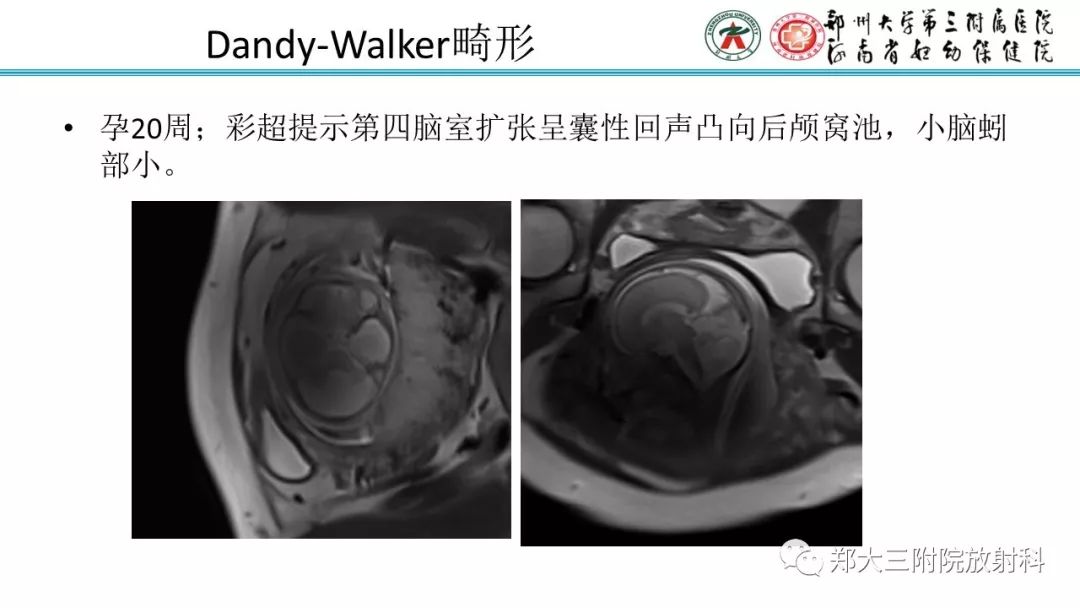 【PPT】胎儿小脑发育及常见疾病的MRI评估 【PPT】胎儿小脑发育及常见疾病的MRI评估