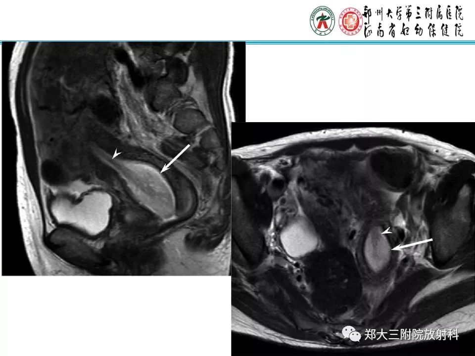 【病例】子宫腺肌瘤性息肉1例MR影像 【病例】子宫腺肌瘤性息肉1例MR影像