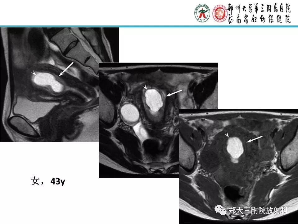 【病例】子宫腺肌瘤性息肉1例MR影像 【病例】子宫腺肌瘤性息肉1例MR影像