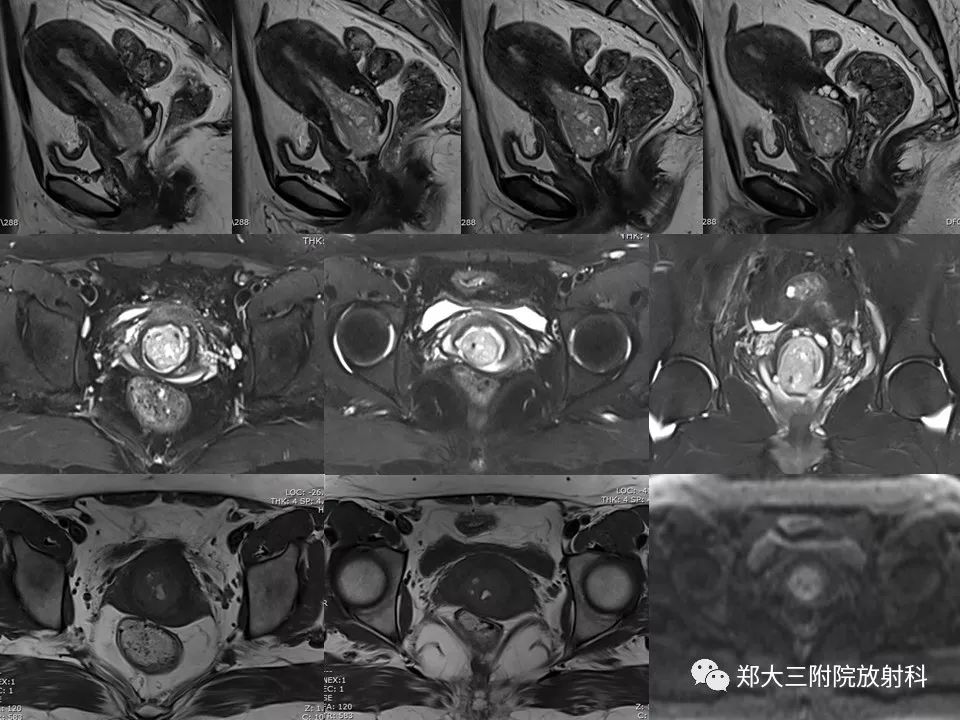 【病例】子宫腺肌瘤性息肉1例MR影像 【病例】子宫腺肌瘤性息肉1例MR影像