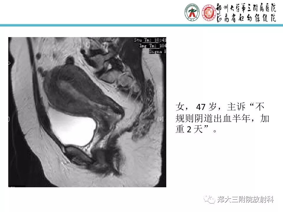 【病例】子宫腺肌瘤性息肉1例MR影像 【病例】子宫腺肌瘤性息肉1例MR影像