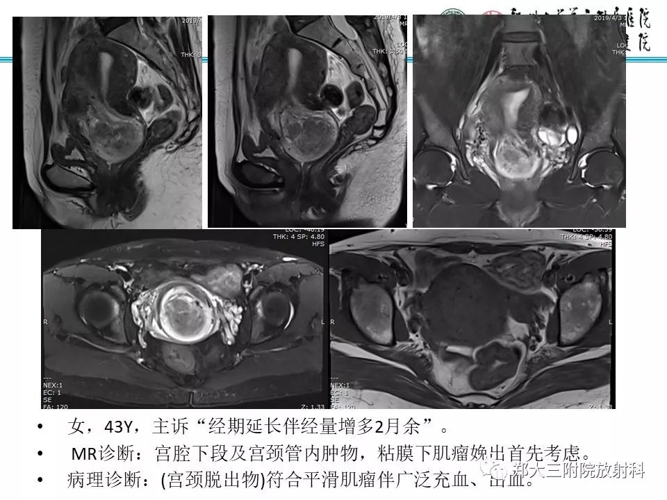 【病例】子宫腺肌瘤性息肉1例MR影像 【病例】子宫腺肌瘤性息肉1例MR影像