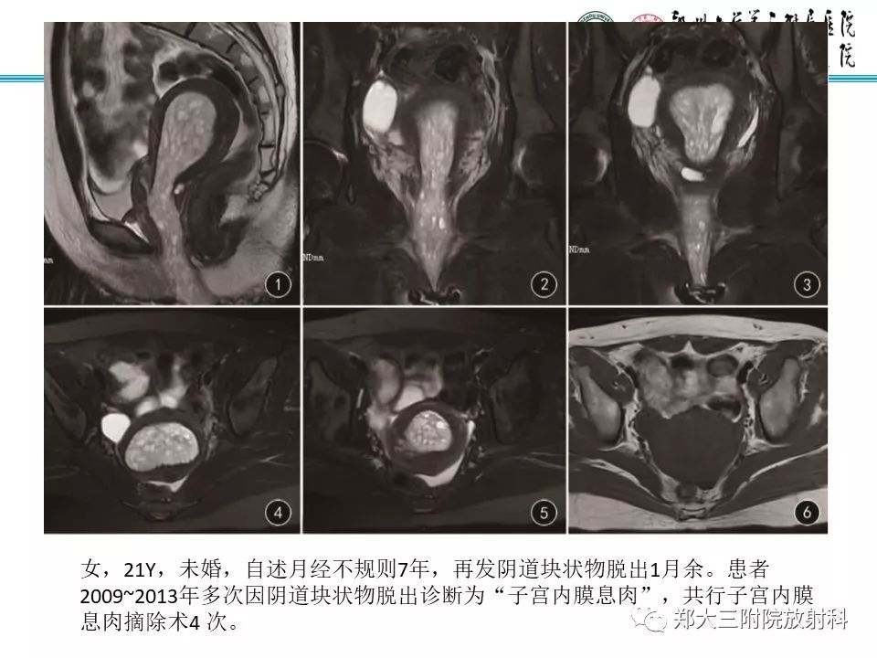 【病例】子宫腺肌瘤性息肉1例MR影像 【病例】子宫腺肌瘤性息肉1例MR影像