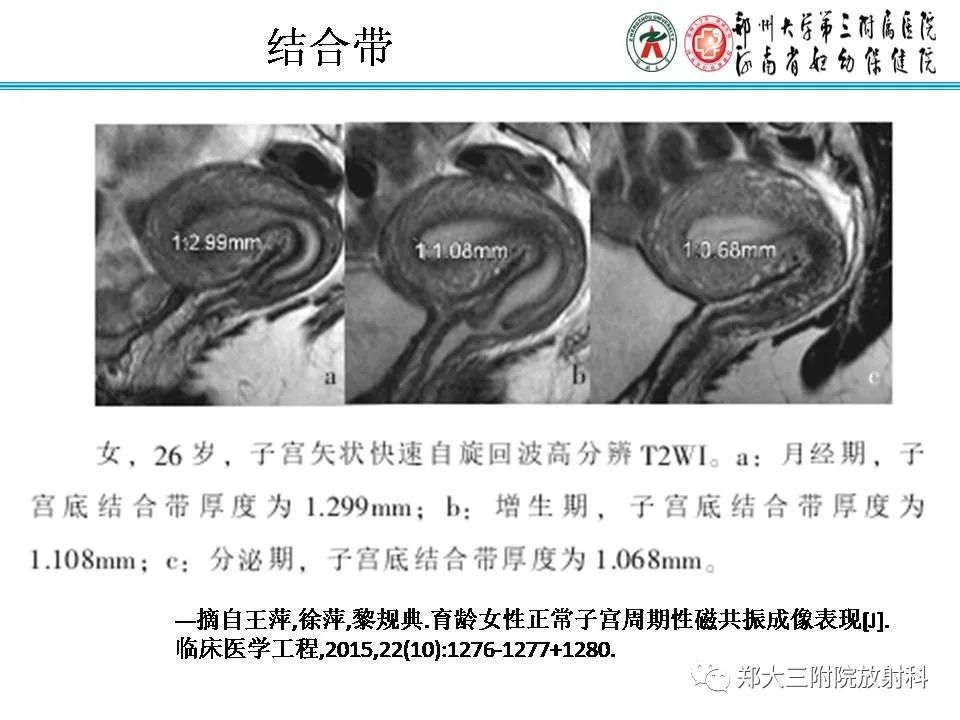 【PPT】育龄期女性正常子宫的MRI表现