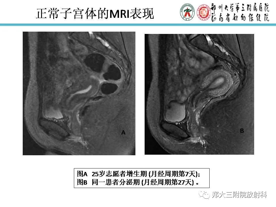 【PPT】育龄期女性正常子宫的MRI表现