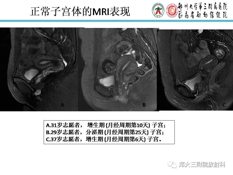 【PPT】育龄期女性正常子宫的MRI表现