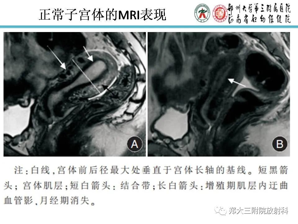 【PPT】育龄期女性正常子宫的MRI表现
