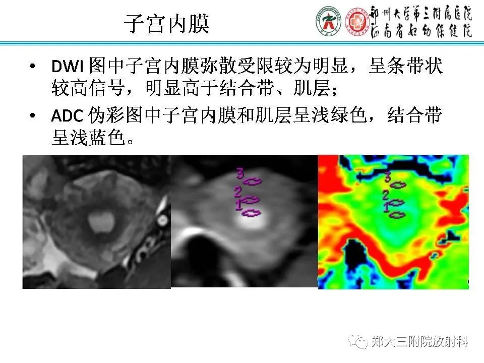 【PPT】育龄期女性正常子宫的MRI表现