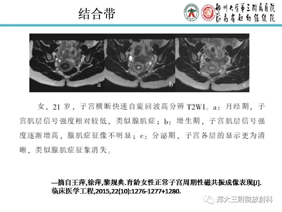 【PPT】育龄期女性正常子宫的MRI表现