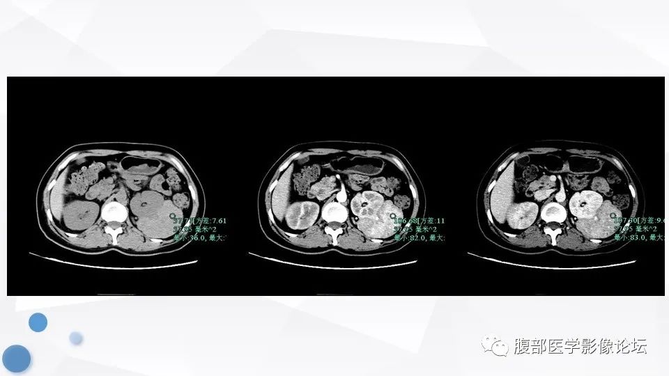 【病例】肾脏上皮样血管平滑肌脂肪瘤1例CT及MR影像