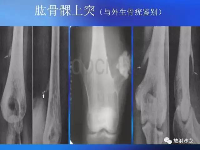 【PPT】骨、关节X线表现、正常变异