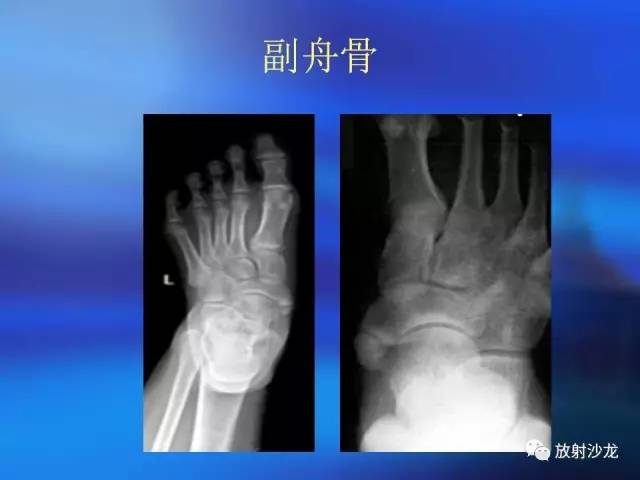 【PPT】骨、关节X线表现、正常变异