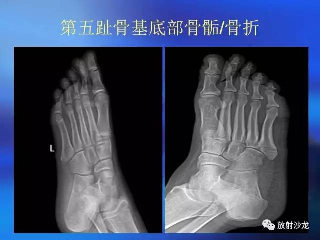 【PPT】骨、关节X线表现、正常变异