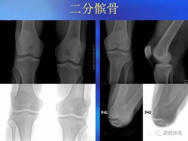 【PPT】骨、关节X线表现、正常变异