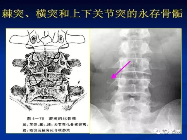 【PPT】骨、关节X线表现、正常变异