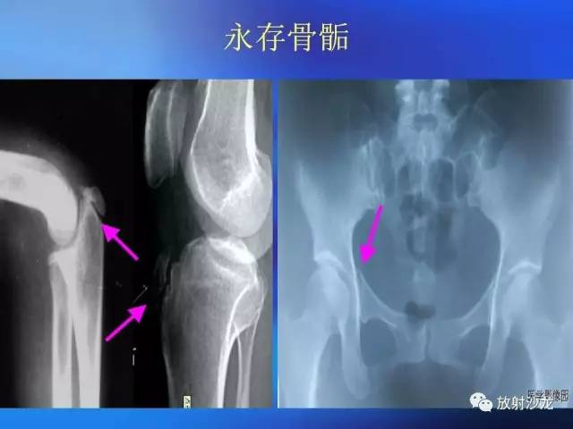 【PPT】骨、关节X线表现、正常变异