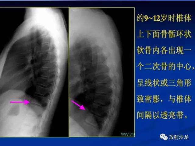 【PPT】骨、关节X线表现、正常变异