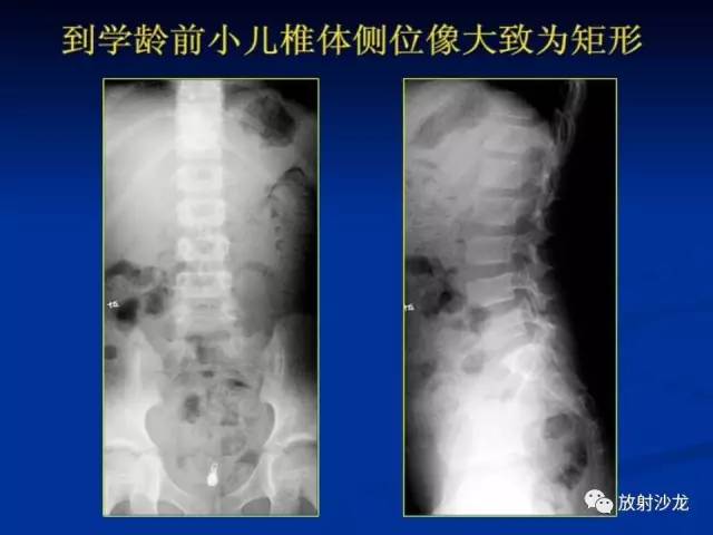 【PPT】骨、关节X线表现、正常变异