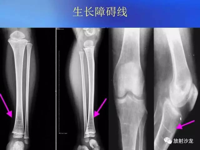 【PPT】骨、关节X线表现、正常变异